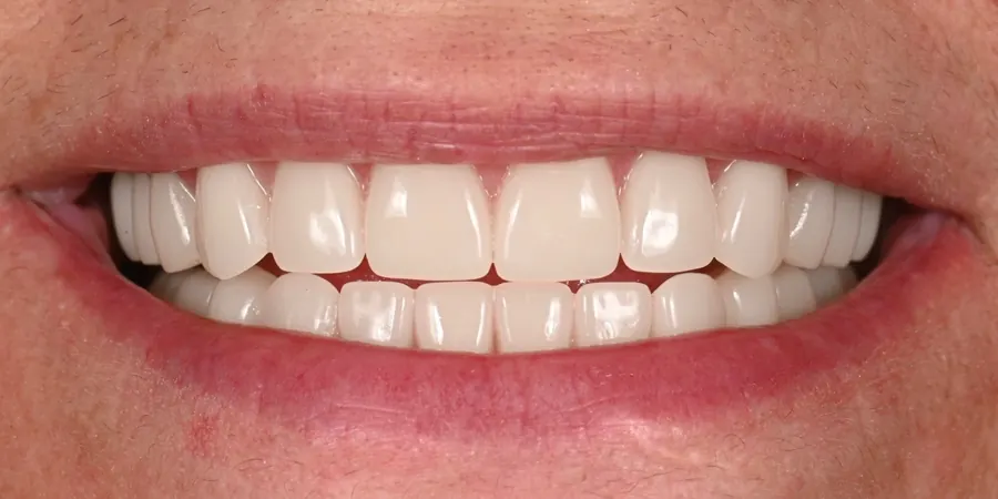 After: A complete, even set of upper and lower teeth.