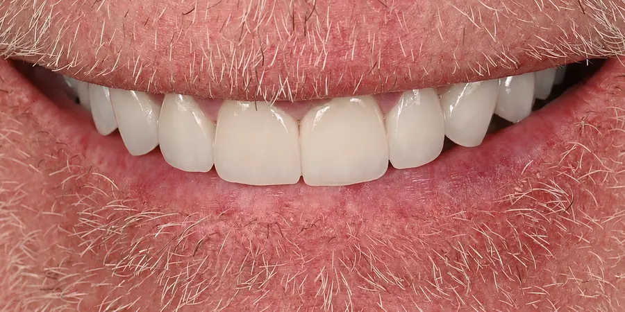 After: Full-length, even front teeth.